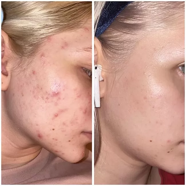 تست روی پوست و نمای نزدیک سرم لاکتیک اسید 5% اوردینری